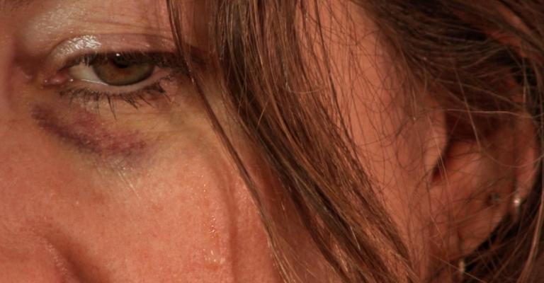 rostro de mujer victima de violencia de genero